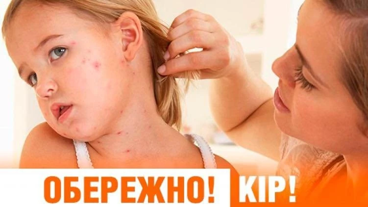 Спалах кору в закарпатських громадах: під ударом опинилися діти без щеплень